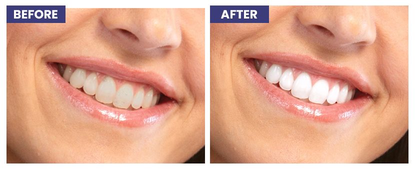 Cosmetic Dentistry in Delhi