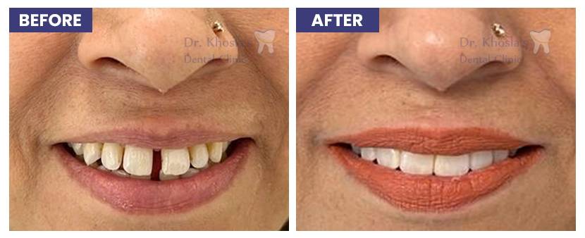 Cosmetic Dentistry in Delhi