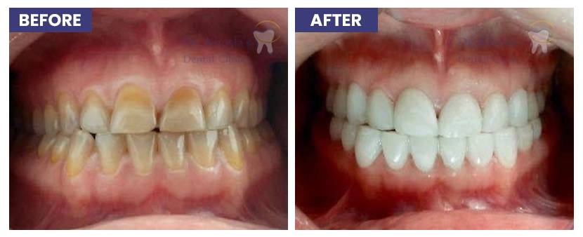 Teeth Whitening in Delhi