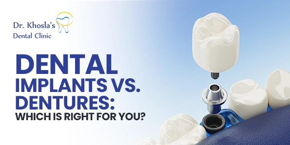Dental Implants vs. Dentures